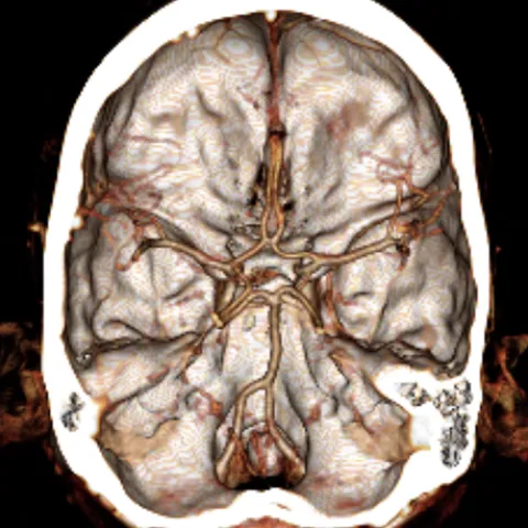 健康・医学 Interventional Neuroradiology Interventional Neuroradiology – Los Angeles, CA | Cedars-Sinai